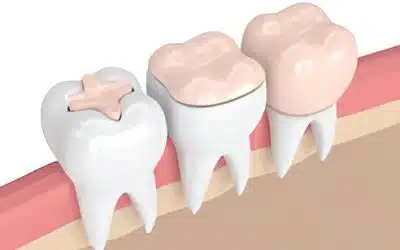 Understanding the Difference: Dental Crowns vs. Fillings