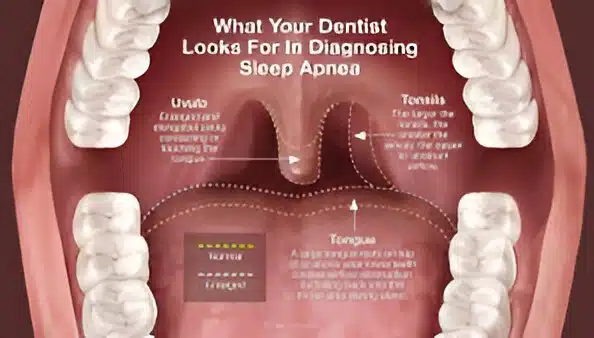 sleep apnea and oral health